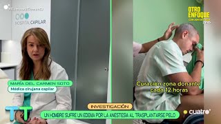 📺 Hospital Capilar en Cuatro | Edema posoperatorio en un injerto capilar