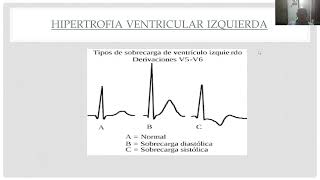 Electrocardiograma patológico Dr  Suva