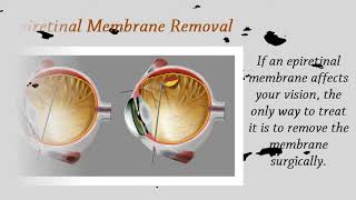 Epiretinal Membrane Surgery By Mahi Muqit