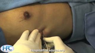 Tube Thoracostomy Video