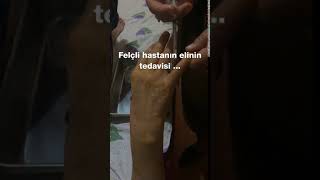 Beyinde tıkanıklık ve felç geçiren hastanın tedavisi