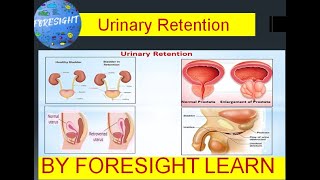 Urinary Retention