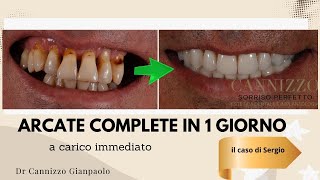 Un caso di implantologia dentale risolto con successo - Studio Dentistico Cannizzo