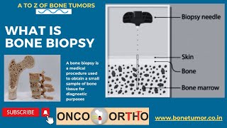 What is Bone Biopsy ?