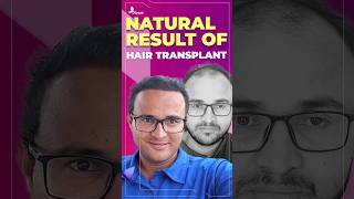 Natural Result of Hair Transplant | Dr. Neeraj Bhaban | Dr. Mayuri Bhaban #hairtransplant #haircare