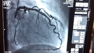 Coronary Arteries X-Ray