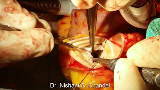 Best Heart Surgeon  in Raipur - Dr. Nishant Chandel