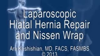 Laparoscopic Hiatal Hernia Repair and Nissen Wrap