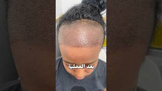 FOREHEAD REDUCTION BY HAIR TRANSPLANT AFTER 6 MONTHS | HAIR TRANSPLANT RESULT