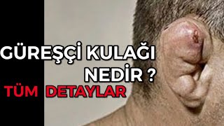 GÜREŞÇİ KULAĞI NEDİR ? 🤼‍♂️