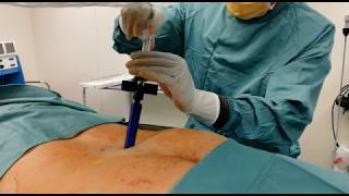 Bone Marrow extraction with Marrow Cellution