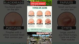 Acne tips #acne #acneremoval #acnetreatment #awareness #skincare #skin #viral #information