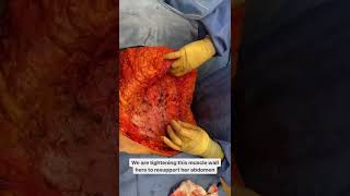 Patient Journey: Revising BBL From Another Surgeon + Extended Tummy Tuck