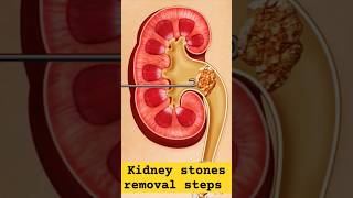 #preclinical #prehealth #kidneydisease #kidneyfailure #kidneystone #kidneydonor #kidneydialysis