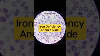 iron deficiency anemia microscope | microscope | hematology microscope #anemiaslide #labstatus