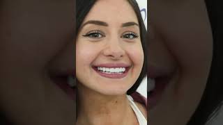 TEETH DONE IN TURKEY | VENEERS, CROWNS, IMPLANTS IN TURKEY | DENTIST IN TURKEY | 0090 555 564 40 07