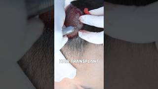 Hair Transplant Result After 10 Days - MOHAMMED ABBAS Hair Transplant Experience