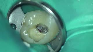 Root canal treatment