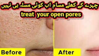 close open pores from face |minimise open pores | open pores |control extra oil from skin |