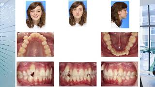 How To Get An Unbiased Second Opinion On Your Orthodontic Treatment