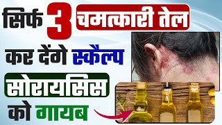 Psoriasis scalp removal | 100% Relief from Scalp Psoriasis: Oils, Tips, and Homeopathy