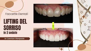 Caso di applicazione di faccette dentali - Cannizzo Studio Milano