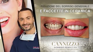 Correzione Sorriso Gengivale e Faccette in Ceramica - Studio Cannizzo