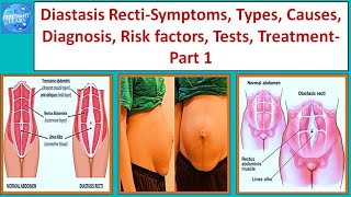 Diastasis Recti Symptoms, Types, Causes, Diagnosis, Risk factors, Tests, Treatment Part 1