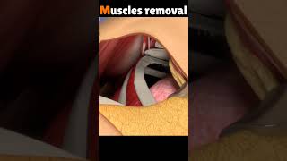 Muscles removal 3D animation video #shorts