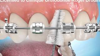 Brossage entre les boîtiers orthodontiques