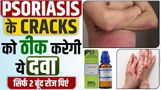 Psoriasis के Cracks को ठीक करेगी ये चमत्कारी दवा | Best Homeopathic Medicine For Psoriasis Cracks