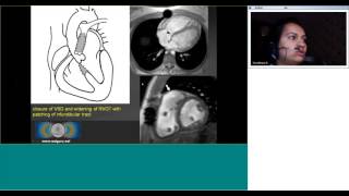 Post operative imaging of congenital heart disease by Dr Jayadeepa.S