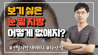 눈밑지방재배치 vs 하안검수술!!눈밑이 불룩해지고 눈가가 처지면 어떤것을 해야할까? (Lower blepharoplasty, TCFR, Eye bag surgery)