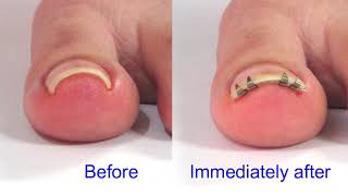 English v4: Ingrown toenail correction device "NailLift" procedure