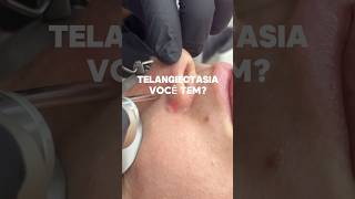 Telangiectasia, você tem?