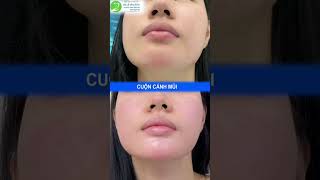 Cuộn Cánh Mũi Sử Dụng Chỉ Gì ? - Thẩm Mỹ Khang Vĩnh