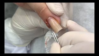 unha encravada na mão | ingrown toenail in hand  #podiatrist #ingrown_toenail #fingernails