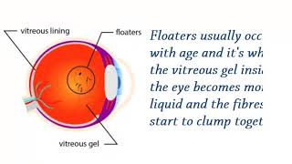 Effective Treatment for Floaters By Mahi Muqit