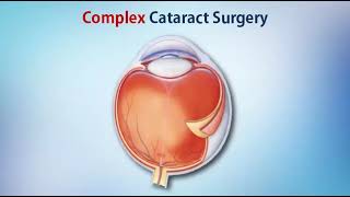 Complex Cataract Surgery  - Mr Mahi Muqit PhD FRCOphth