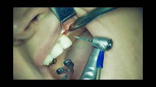 Template for prosthetic implant positioning.