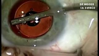 ECP laser for glaucoma during cataract surgery