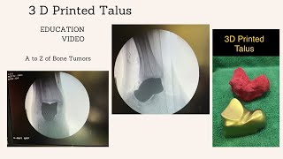 3 D Printed Talus Implant Replacement Surgery: Education Video