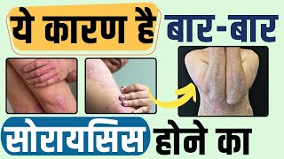 Can Psoriasis Come Back | सोरायसिस दोबारा क्यों होते है? | Psoriasis Dubara Kyu Ho Jata Hai ?