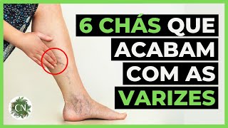 OS 6 MELHORES CHÁS PARA COMBATER AS VARIZES