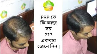 Hair Fall  | Hair Care | Hair Loss