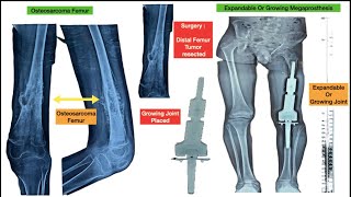 बढ़ते जोड़ Expandable or Growing Joint : चिकित्सा विज्ञान का जादू बच्चों में ट्यूमर Bone Tumors