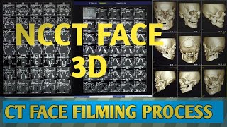 NCCT FACE WITH 3D FILMING PROCESS #NCCT FACE 3D FILMING #CT FACE 3D