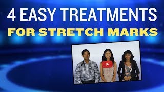 4 Ways to Treat or Prevent Stretch Marks