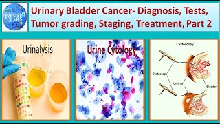 Urinary Bladder Cancer  Diagnosis, Tests, Tumor grading, Staging, Treatment, Part 2