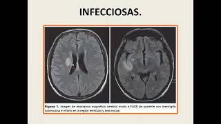 Epilepsia Dr Martinez